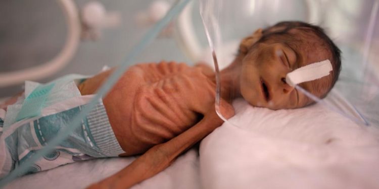 Birleşmiş Milletler: Yemen’de 3 milyondan fazla kişi açlık tehlikesi ile karşı karşıya