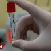 Bazı özel hastaneler fazla ücret alıp koronavirüs test sonuçlarını sisteme girmemiş
