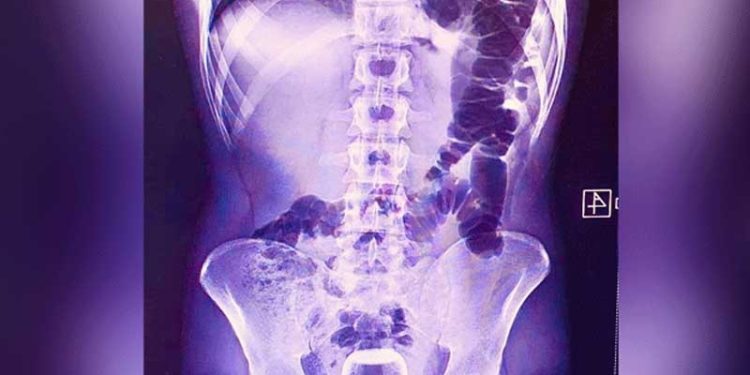 Hacamat yaptırırken anüsüne kaçan çay bardağını uzman doktorlar çıkardı