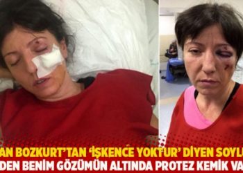 Nazan Bozkurt&rsquo;tan &lsquo;İşkence yoktur&rsquo; diyen Soylu&rsquo;ya: Neden benim g&ouml;z&uuml;m&uuml;n altında protez kemik var?