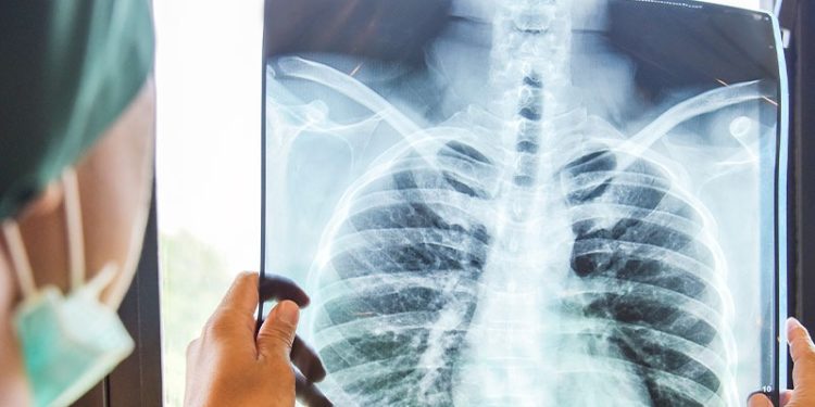 Pandemi döneminde akciğer kanseri tanısı oranı 5 kat arttı