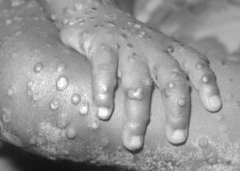 Nadir görülen maymun çiçeği virüsü nedeniyle ABD'de 200 kişi takip altında