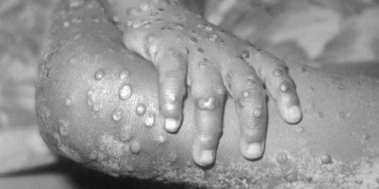 Nadir görülen maymun çiçeği virüsü nedeniyle ABD'de 200 kişi takip altında