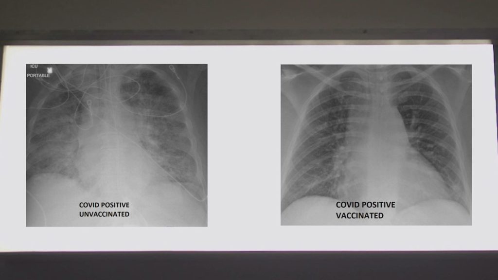 ABD'de bir doktor aşılı ve aşısız Covid-19 hastalarının röntgenlerindeki farkı paylaştı