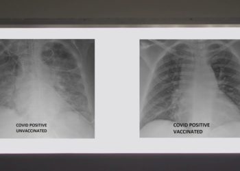 ABD'de bir doktor aşılı ve aşısız Covid-19 hastalarının röntgenlerindeki farkı paylaştı