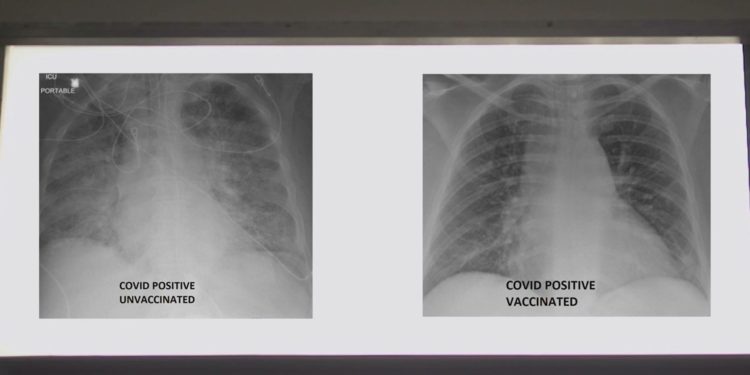 ABD'de bir doktor aşılı ve aşısız Covid-19 hastalarının röntgenlerindeki farkı paylaştı