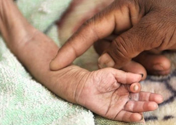 UNICEF: Yemen'de her 10 dakikada bir çocuk yetersiz beslenme ve önlenebilir hastalıklar yüzünden ölüyor