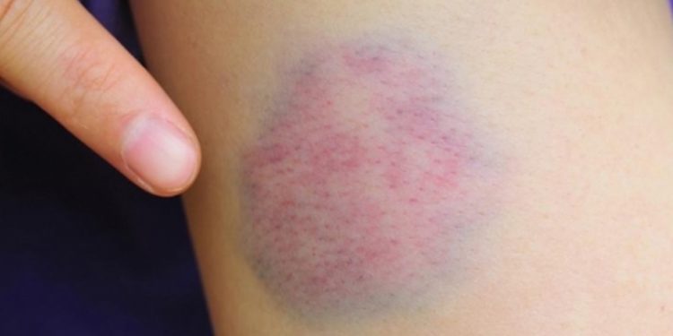 Vücutta solukluk ve morarma, kanser belirtisi olabilir