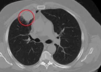 Kovid-19, akciğer kanserini taklit etti; ameliyattan son anda vazgeçildi