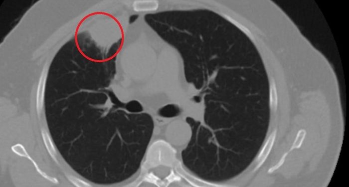 Kovid-19, akciğer kanserini taklit etti; ameliyattan son anda vazgeçildi