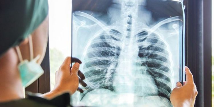 Prof. Kutlu: Hızla yaygınlaşan akciğer kanseri en sık görülen ikinci kanser türü