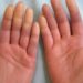 Romatoloji uzmanından uyarı: Raynaud Sendromu enfeksiyona neden olabilir