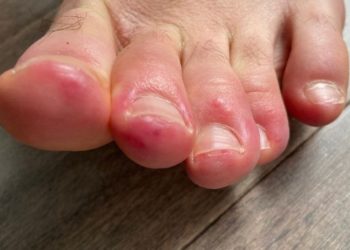 Covid-19 virüsü bazı hastalarda niçin el ve ayak morarmasına sebep oluyor?