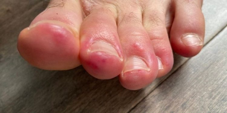 Covid-19 virüsü bazı hastalarda niçin el ve ayak morarmasına sebep oluyor?