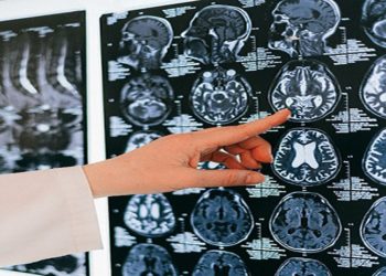 Doç. Dr. Topçu: Serebral palsi hastalığıyla ilgili çocuklarda ilk 3 yaşa dikkat