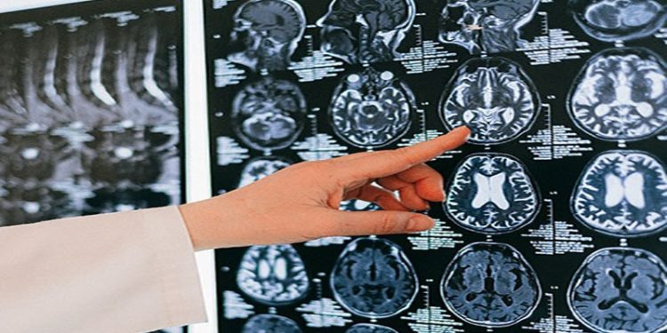 Doç. Dr. Topçu: Serebral palsi hastalığıyla ilgili çocuklarda ilk 3 yaşa dikkat