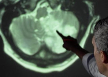 Doç. Dr. Ümit Savaşçı: Covid-19 geçirenlerin beyninde küçülme tespit edildi