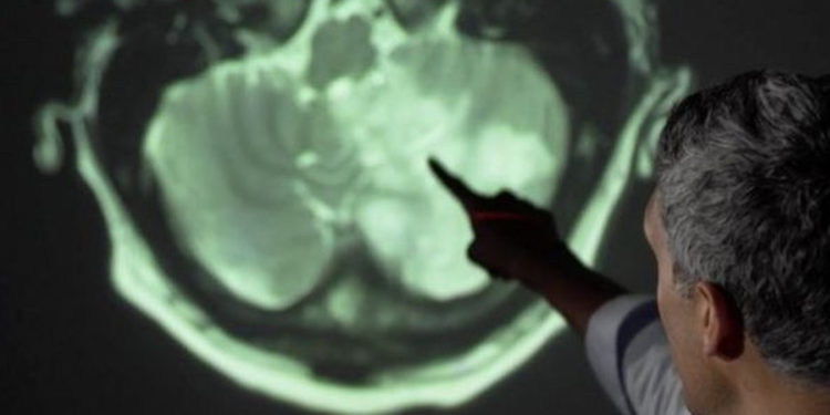 Doç. Dr. Ümit Savaşçı: Covid-19 geçirenlerin beyninde küçülme tespit edildi