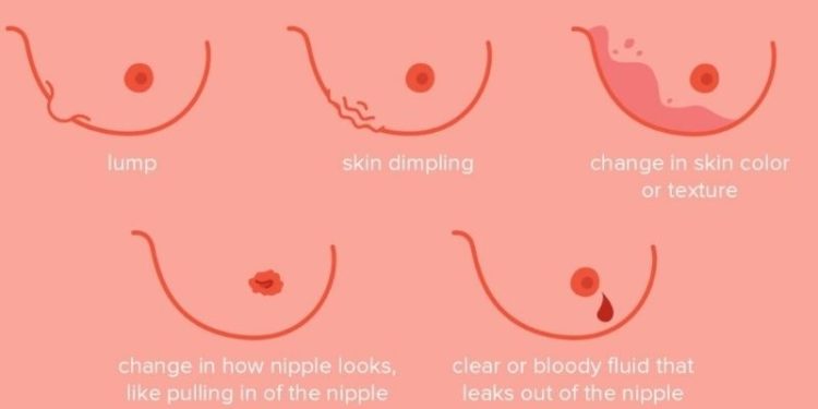 Fazla kilolar meme kanseri için de riskli