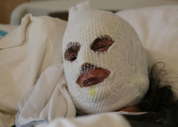 Gaz kaçağını çakmakla kontrol eden kadın ağır yaralandı