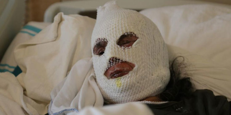 Gaz kaçağını çakmakla kontrol eden kadın ağır yaralandı