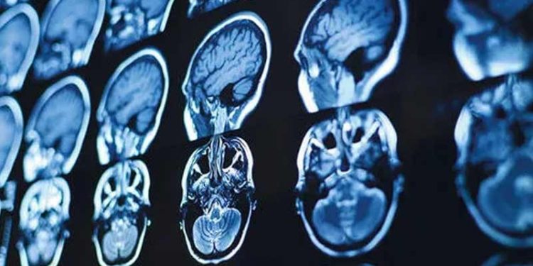 Prof. Müftüoğlu: Covid-19 beyni küçültüyor