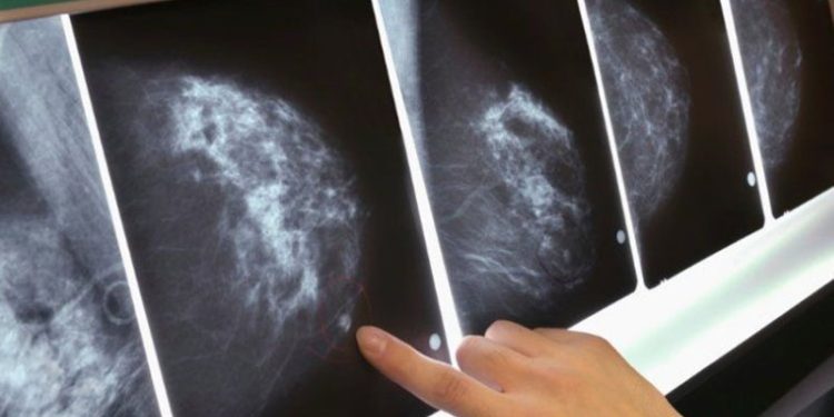 Türkiye’de her 8 kadından 1'i meme kanserine yakalanıyor
