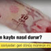TL’deki kan kaybı nasıl durur?