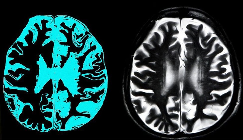 AB, Alzheimer tedavisi için geliştirilen ilaca kullanım onayı vermedi