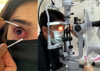 Bu kez de gözlerde salgın başladı: Adenovirüs