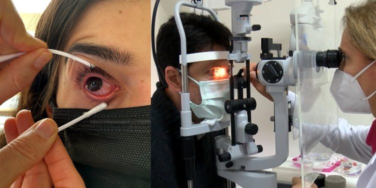 Bu kez de gözlerde salgın başladı: Adenovirüs