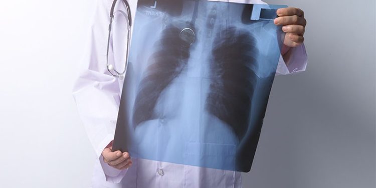 Covid-19 verem tanılarını geciktirdi