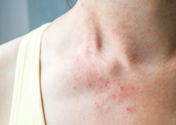 Cilt sorunları Covid-19 belirtileri arasına girdi!