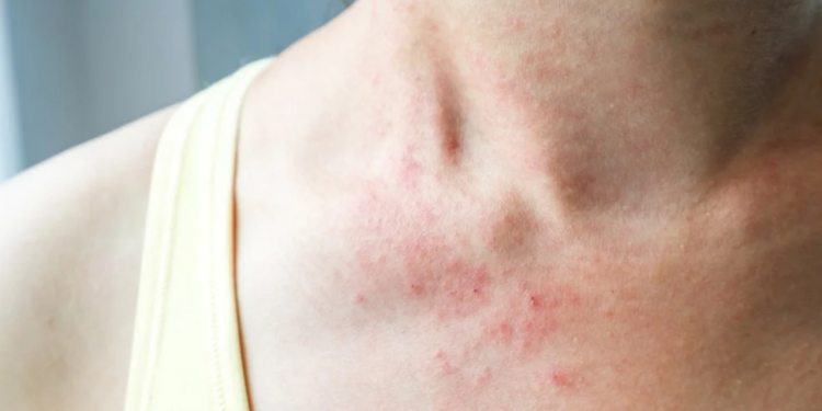 Cilt sorunları Covid-19 belirtileri arasına girdi!