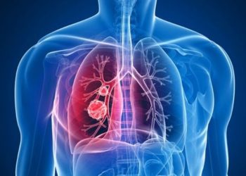 Bilim Kurulu Üyesi: Nüfusun yüzde 30’unda gizli tüberküloz var