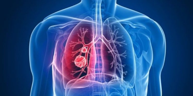 Bilim Kurulu Üyesi: Nüfusun yüzde 30’unda gizli tüberküloz var