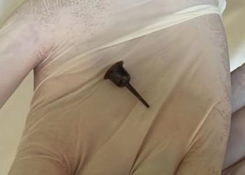 9 yıl soluk borusunda mum tutacağı ile yaşadı