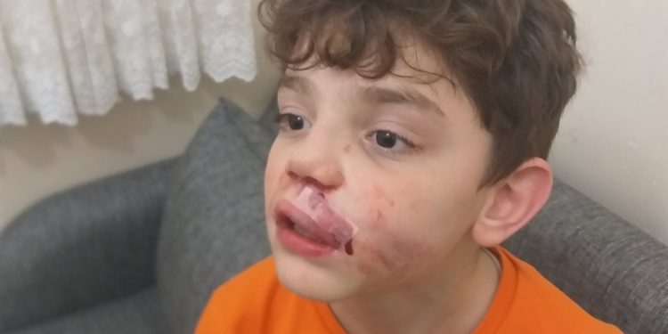 Burnu kırık ve dudağı patlak çocuğu, hastanede saatlerce beklettiler