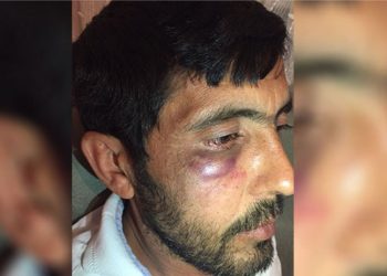 Park yeri tartışmasında 'polis şiddeti': Yüzünde morluklar oluşan yurttaş şikayetçi oldu