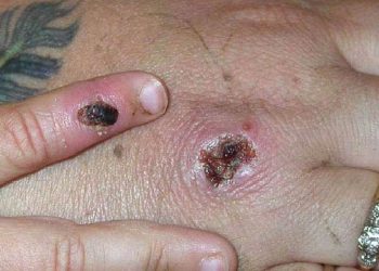 Birleşmiş Milletler'den maymun çiçeği virüsüyle ilgili ırkçılık ve homofobiyi besleyen haberlere tepki