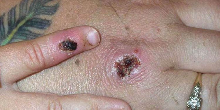 Birleşmiş Milletler'den maymun çiçeği virüsüyle ilgili ırkçılık ve homofobiyi besleyen haberlere tepki