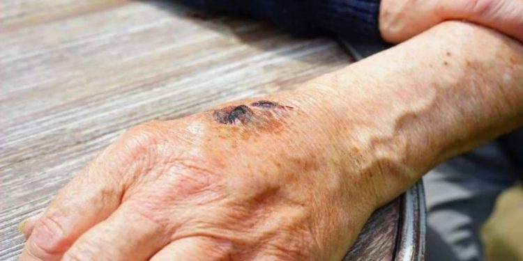 DSÖ: 11 ülkede 80 maymun çiçeği vakası var