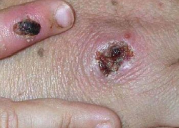 DSÖ: Maymun çiçeği kontrol altına alınabilir