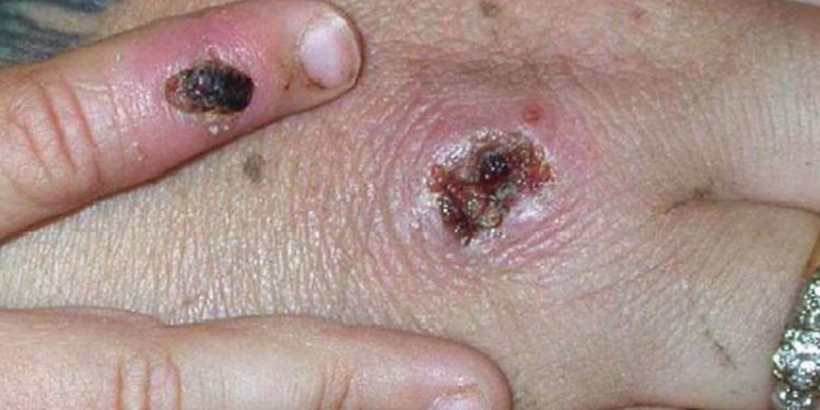 DSÖ: Maymun çiçeği kontrol altına alınabilir