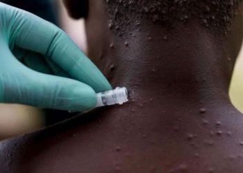 Maymun çiçeği vaka sayısı İngiltere'de 20'ye ulaştı