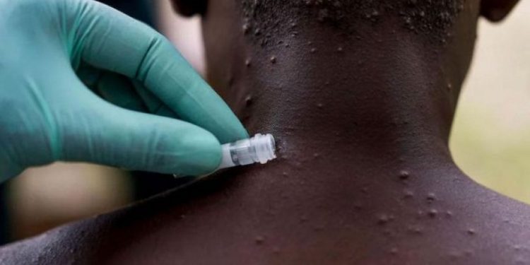 Maymun çiçeği vaka sayısı İngiltere'de 20'ye ulaştı