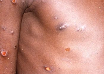 Maymun çiçeği vakalarında artış endişe yaratıyor