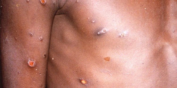 Maymun çiçeği vakalarında artış endişe yaratıyor