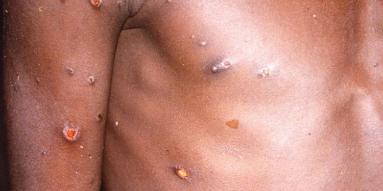 Maymun çiçeği virüsü Avrupa'nın ardından ABD'de de görüldü