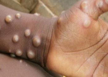 Maymun çiçeği virüsü nedir, nasıl bulaşır, hastalığın tedavisi var mı?